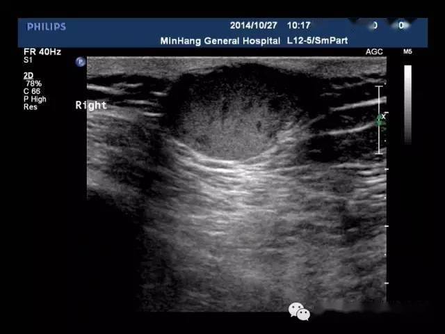 【超声随响】第03期 表皮样囊肿 epidermoid cyst