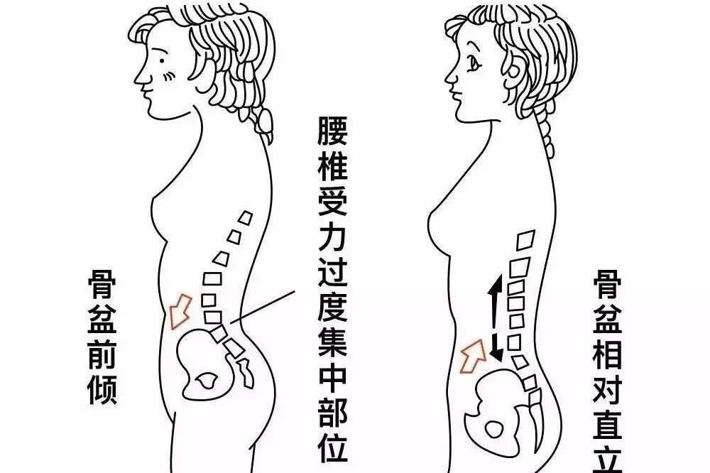 腹部凸出不一定是肥胖也有可能是骨盆前倾造成的,一组动作纠正骨盆