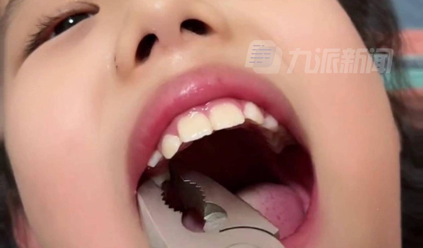 女儿拔乳牙，还没反应过来牙就掉了：她嫌去医院麻烦，主动要求用钳子。