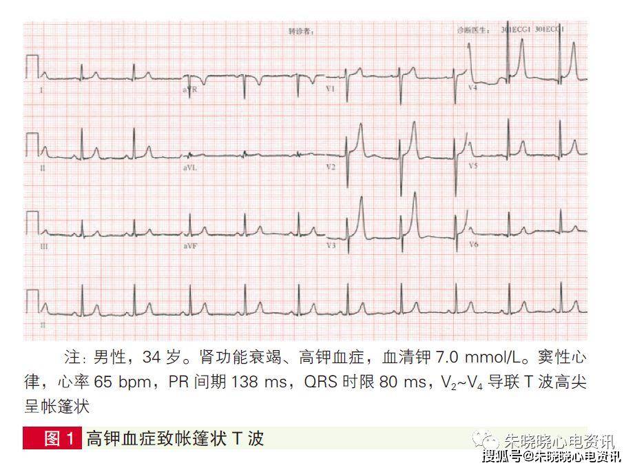 不同范围的血清钾浓度心电图表现略有不同: ① 血清钾在5.5~6.