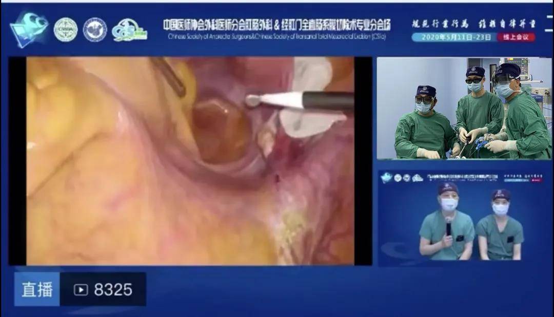 3d腹腔镜直肠肛管癌elape手术(术者:傅传刚,鲁兵教授团队)