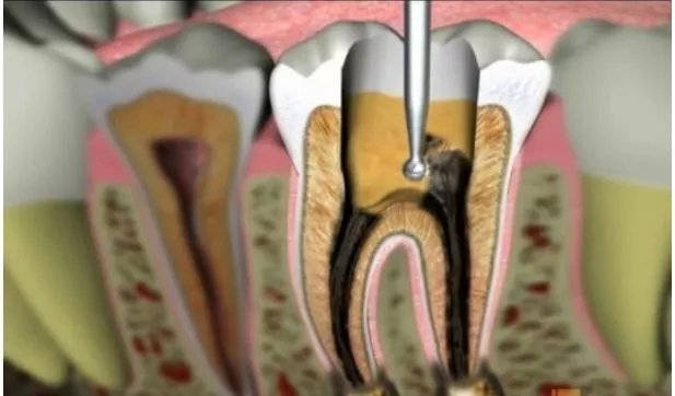 出了问题的牙神经会在牙齿内部腐坏,发酵,造成严重的感染和疼痛.