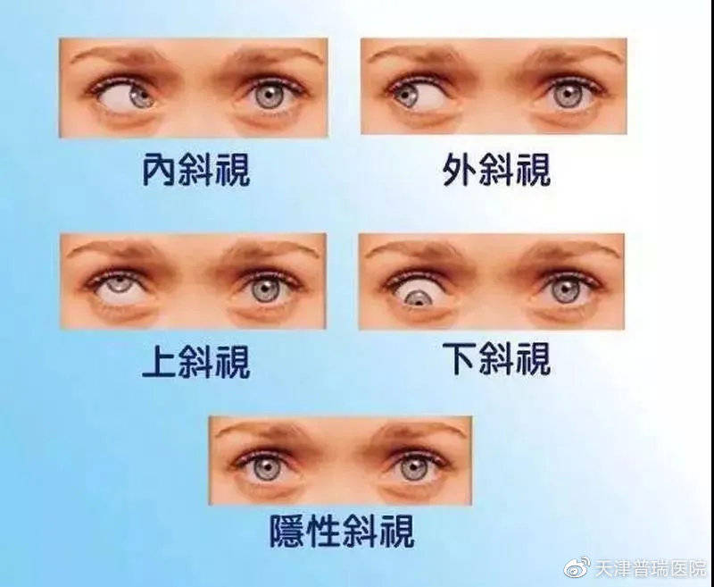 儿童斜弱视