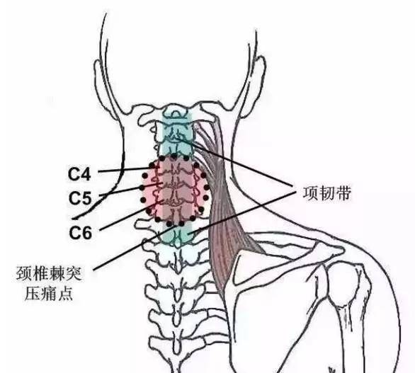 6,颈椎横突尖压痛点颈1--4横突尖为提肩胛肌上端附着处,无菌性炎症