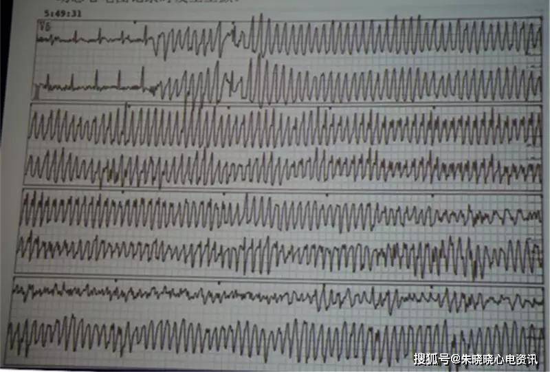图3.室颤心电图.图4. 有"r-on-t"表现的心电图.4.