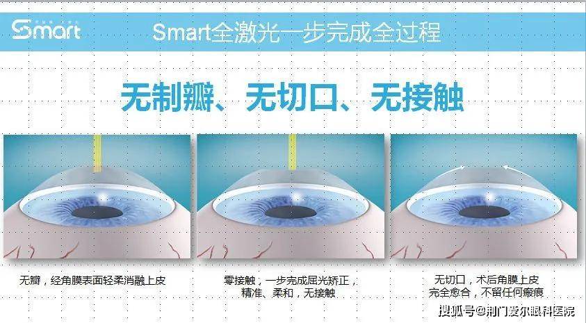 全飞秒近视手术的原理_全飞秒(3)