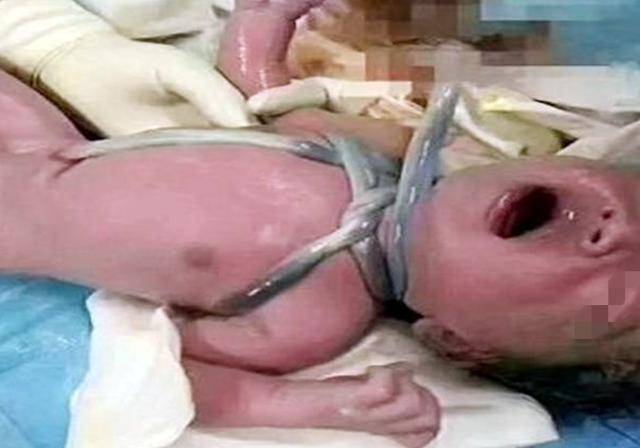 新生儿被“捆绑”出生？孕期的这些错误习惯，建议孕妈尽快戒掉