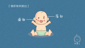 宝宝■新手爸妈要这样做！宝宝湿疹难缠