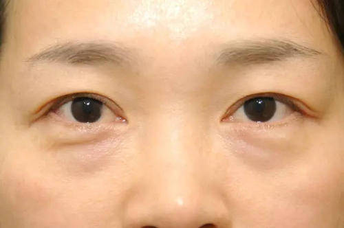 眼袋手术能否解决皱纹问题？皮肤过敏影响手术效果吗？