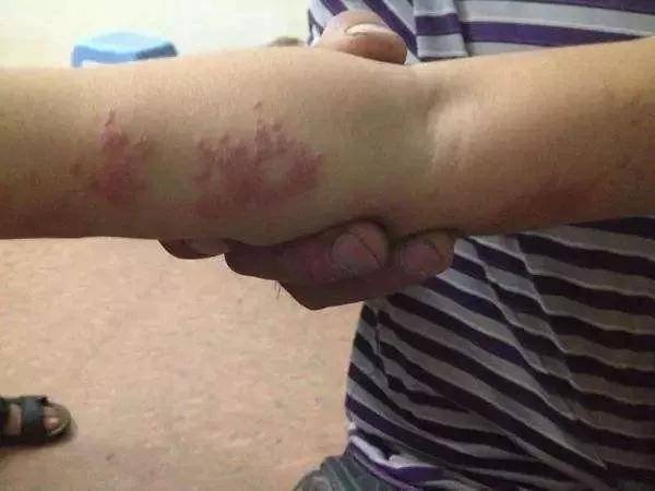"蛇盘疮""缠腰龙"带状疱疹,绕腰一圈要人命?