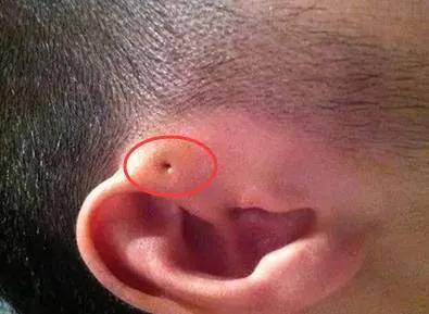 宝宝耳朵上长了"肉疙瘩",有小孔,需要切除治疗吗?