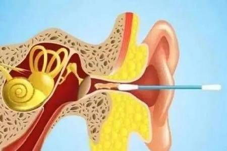 首大戴海江耳屎与健康有什么关系正常人并不需要掏耳朵