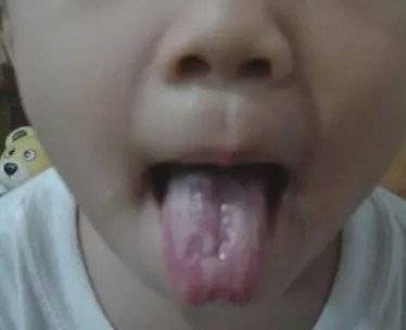 孩子|宝宝身体健康状况早知道，防患于未然！捏积派——学会舌诊