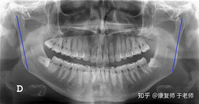 人口下颌义齿_全口义齿下颌解剖标志