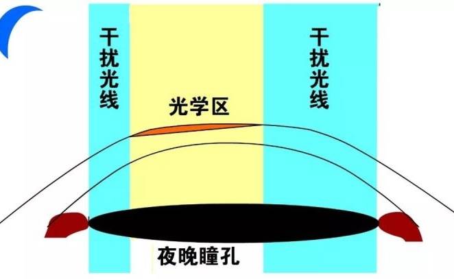 为什么术后夜间容易看不清?