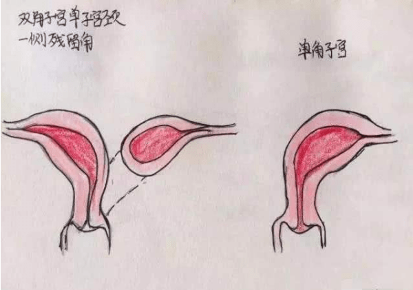 什麼是單角子宮？單角子宮懷孕幾周最危險？《網路文章》