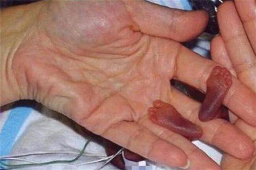 吉尼斯|一个女婴出生时仅25厘米，打破吉尼斯纪录，如今怎样18年前