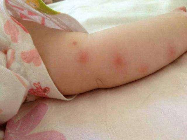 皮肤|4个技巧解决难题宝宝经常被蚊子叮咬的皮肤红肿？宝妈别急