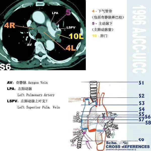 今日分享 — 纵隔淋巴结分区图谱