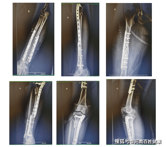 十个小时 七个术式 , 市一院航空港院区为十余处骨折女子神奇接骨