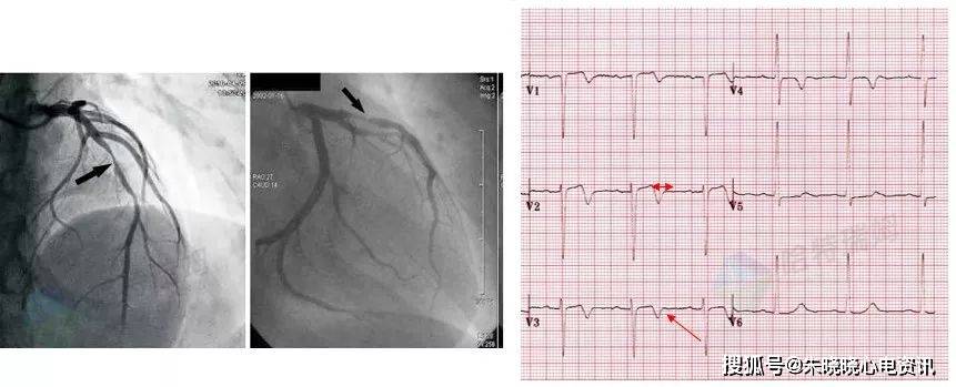 形形色色的t波倒置你了解多少