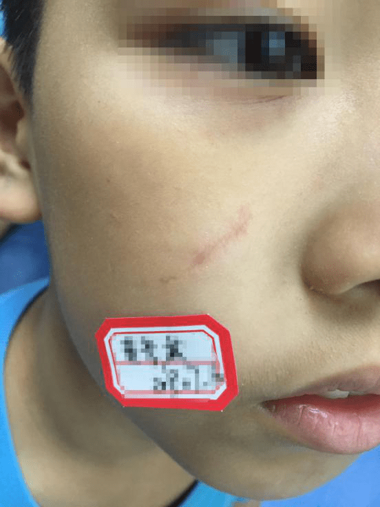 济南现代皮肤病医院:孩子脸上抓伤疤痕如何去除?