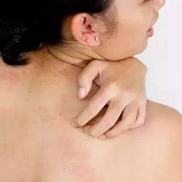 身上干燥发痒怎么回事 ba6c792103a34351a150e57c5dec5df4.jpeg