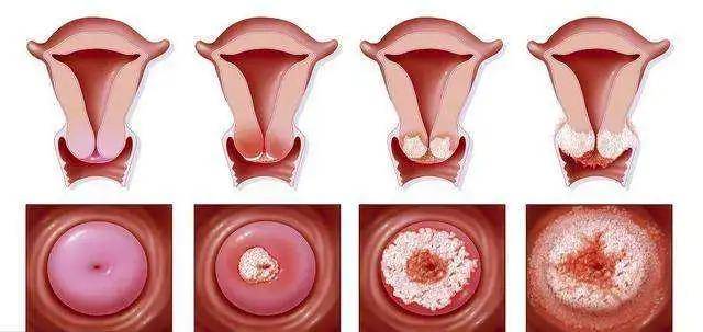 宫颈炎放置不理,会癌变吗?