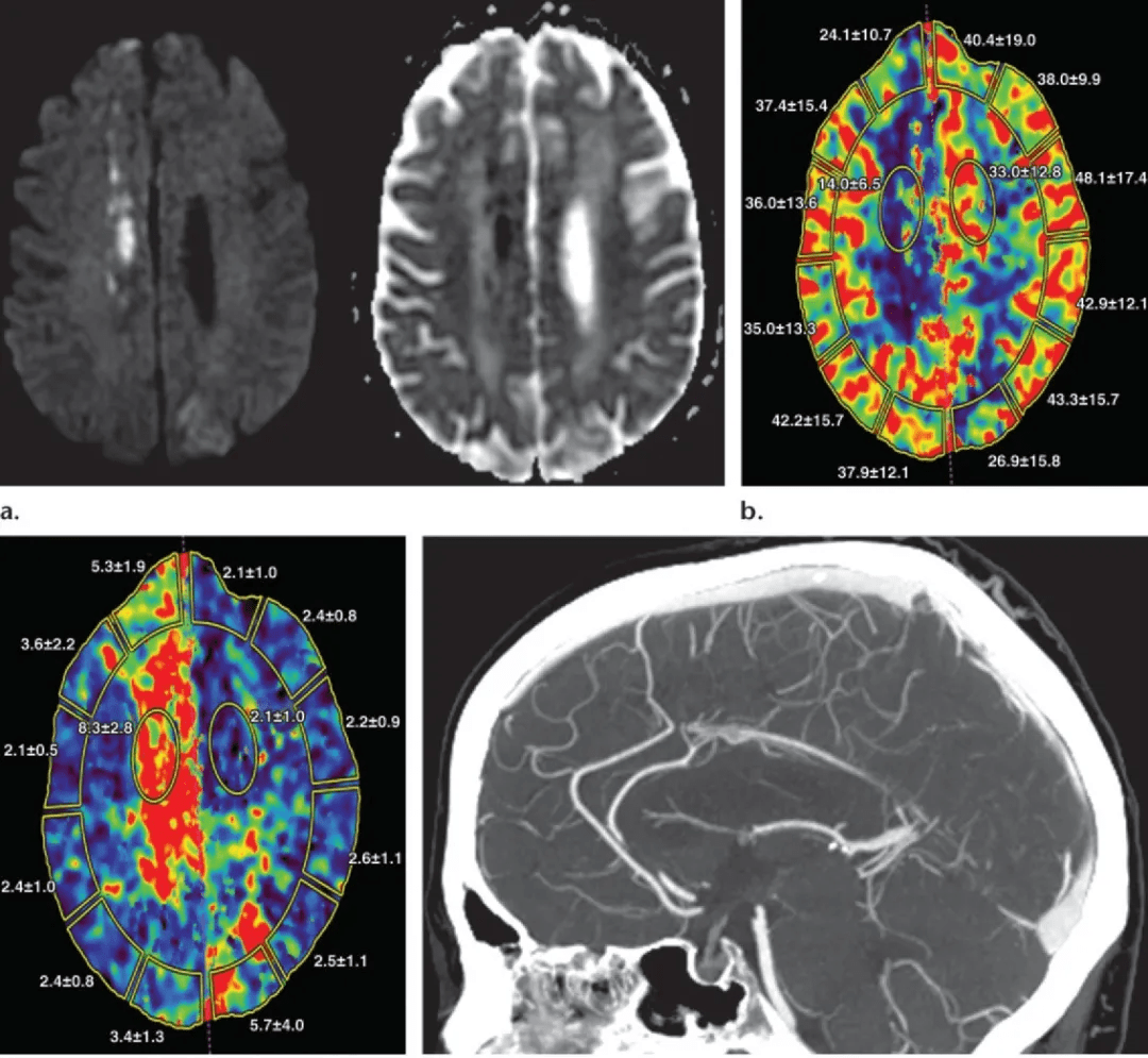 (a)dwi 及 adc 像显示:右侧大脑前动脉区域存在急性梗死区.