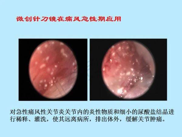 痛风石微创针刀镜操作流程典型病例分享针刀镜在痛风石治疗中的意义1