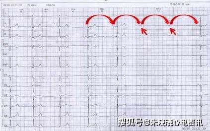 夜间多次心脏骤停原来是得了这种病