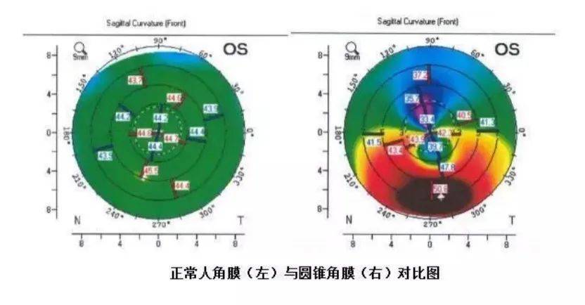 近视矫正手术的原理_从原理讲透彻 东莞全飞秒近视手术的利与弊(2)