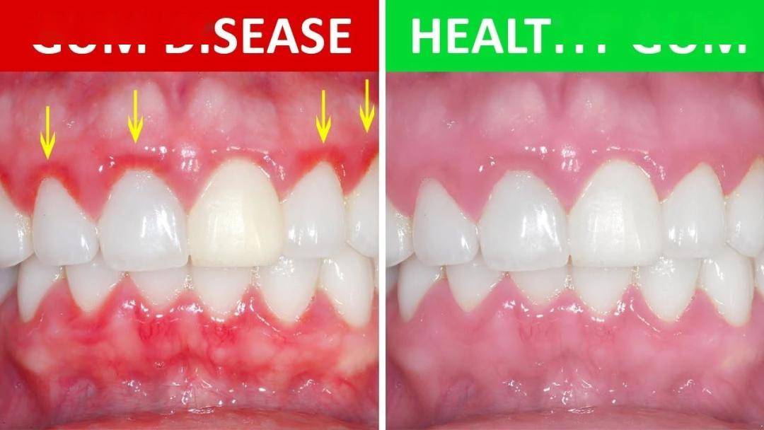 怎样去牙龈里的结石 53736a2686cd4fe2be01a1f582ad8266.jpeg