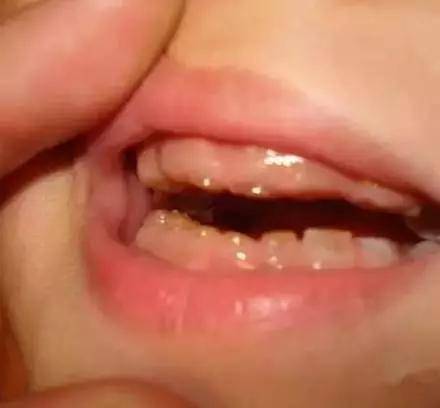 爸妈|惨！小孩1月内牙齿全部掉光！只因爸妈不注意这件事情...