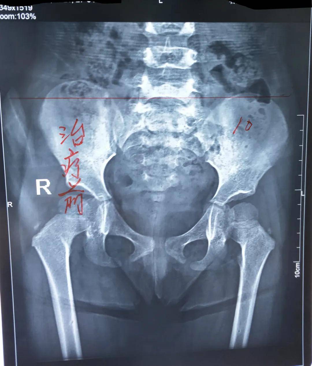 男童走路长短腿被诊为"骨盆行扭",中医这个方法一次见效,二次痊愈!