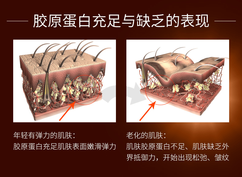 3,胶原蛋白流失 随着年纪的增大,时间的推移,皮下真皮层胶原蛋白已经