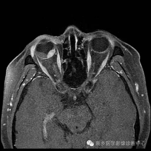 色素瘤是怎么样的 2454aaa23b2f4c89a9e3b17c57718c0a.jpeg