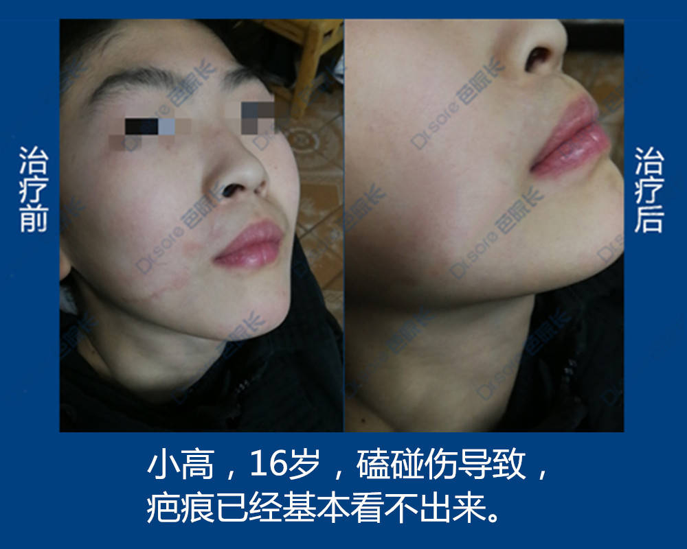 受伤后如何预防留疤 6bc3109aa22d497a99d746be5d84f4c1.jpeg