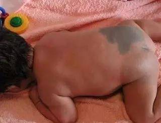 孩子各种胎记、血管瘤、斑、痣全面分析！