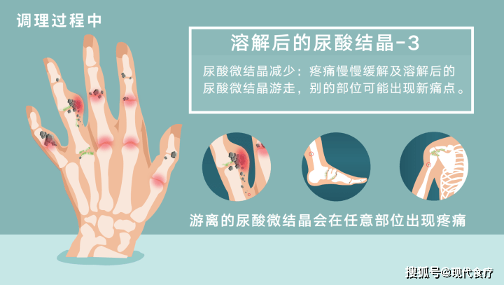 痛!痛!痛风调理过程中的溶晶痛知多少