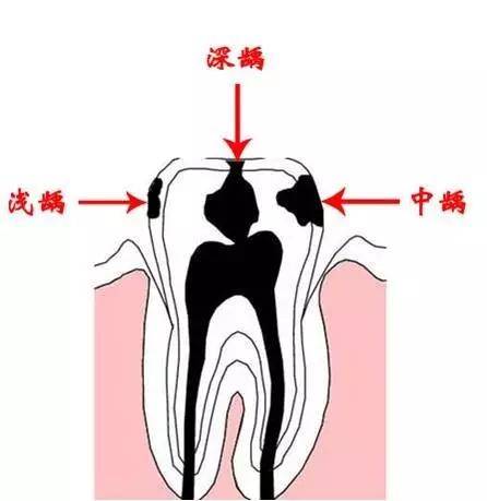 深度瘸齿:龋