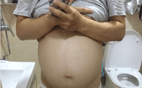 肚子脂肪层在皮下几毫米 3ac3b849f02d4af88e4120c8ced3190c.png