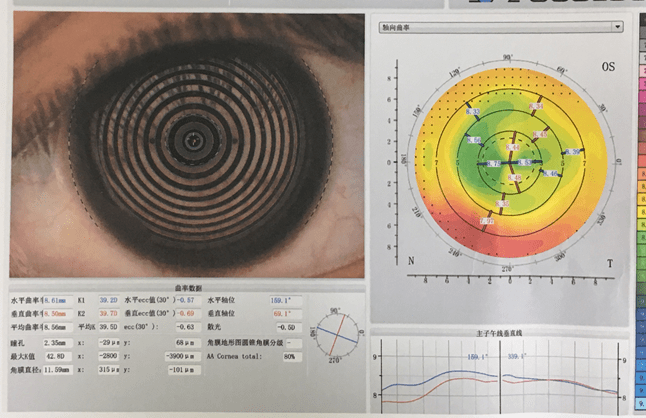 高度屈光参差,角膜屈光术后|配戴目立康安氧视rgp的临床案例效果分析
