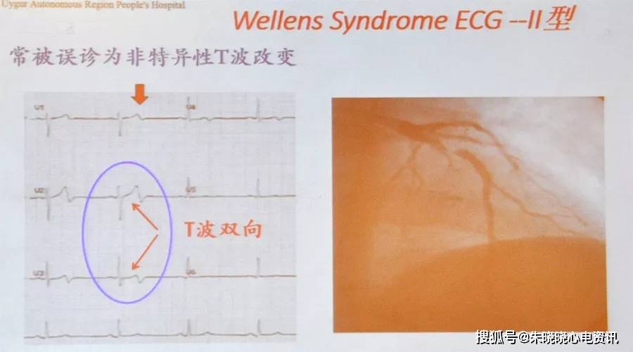 冯艳:急性胸痛的心电图诊断思路