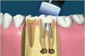 牙齿蛀掉了一半怎么办