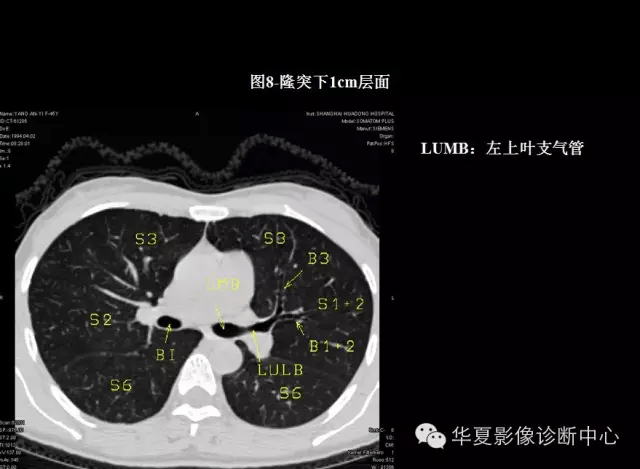 肺段ct解剖终于搞清楚了
