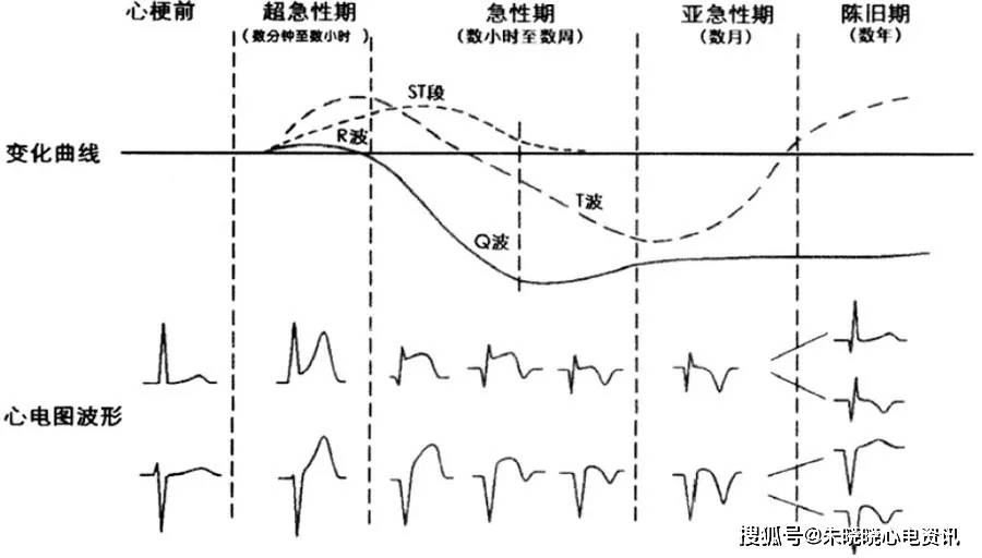 冯艳:急性胸痛的心电图诊断思路