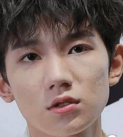 原创王源才20岁脸就毁了?脸上坑坑洼洼的太吓人,小汤圆们瞬间脱粉