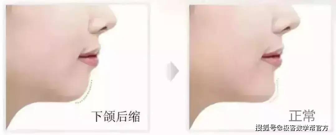 牙齿|家长请注意：孩子12岁前必须矫治的几种牙齿畸形