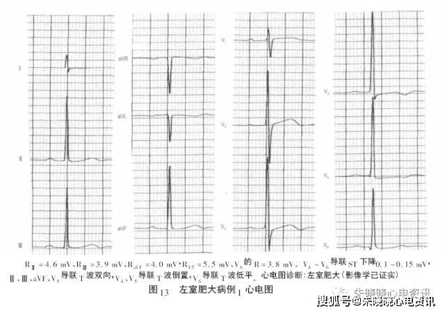 心房心室肥大的心电图诊断